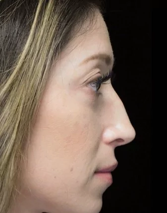 before and after photo on a left profile view of a non-smiling female asian patient  who underwent scarless rhinoplasty
