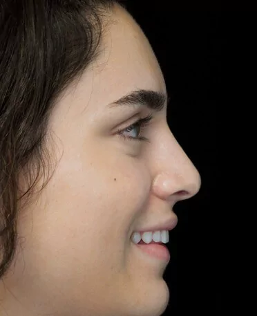 before and after photo on a left profile view of a smiling female patient with asymetric nose who underwent non surgical rhinoplasty