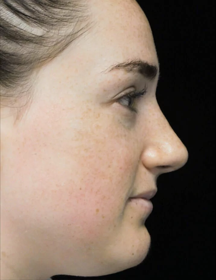 before and after photo on a left profile view of a non-smiling female patient with boxy nose who underwent scarless rhinoplasty