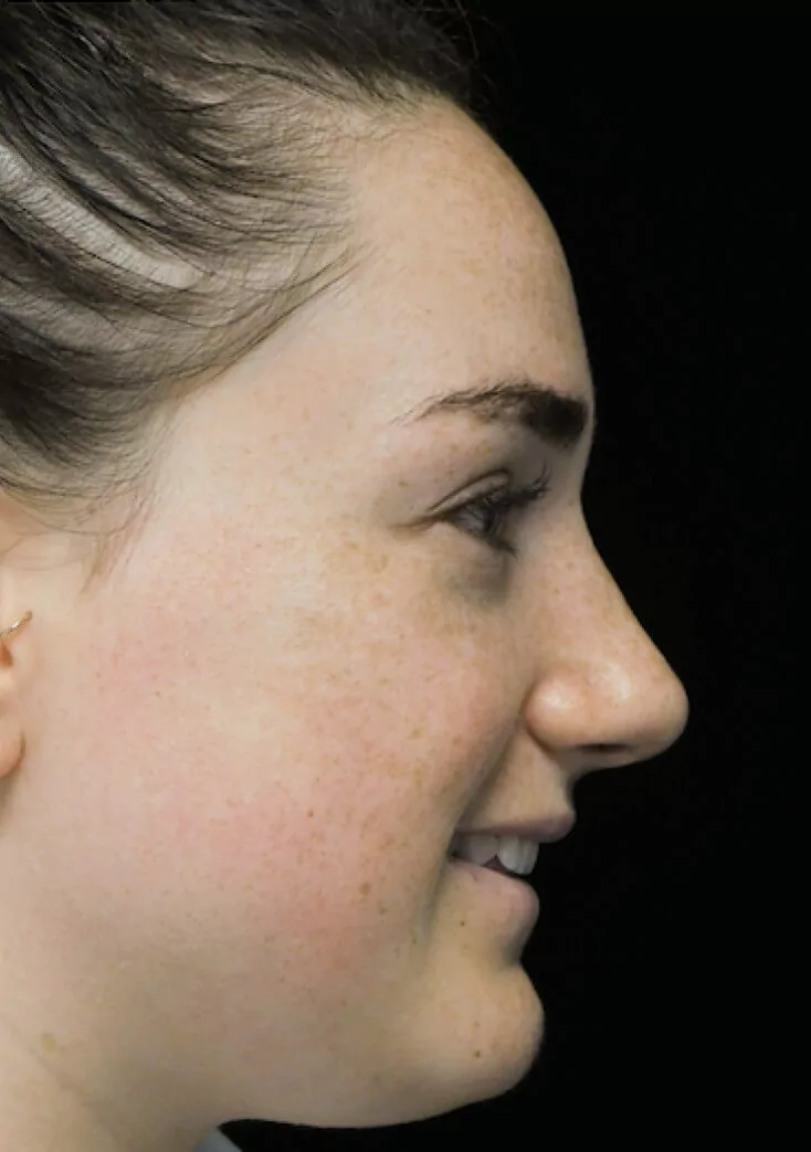 before and after photo on a left provile view of a smiling female patient with boxy nose who underwent scarless rhinoplasty