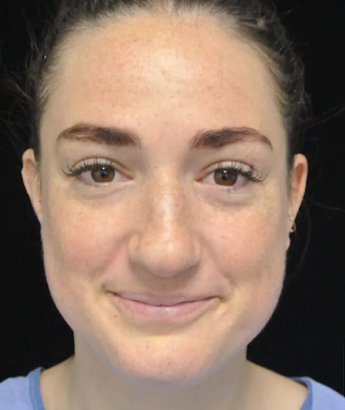before and after frontal view photo of a smiling female patient with boxy nose who underwent scarless rhinoplasty