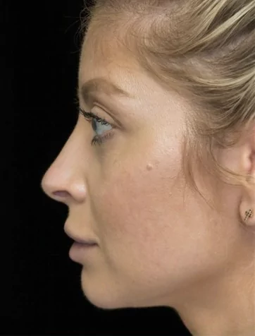 before and after photo on a right profile view of a non-smiling female patient with crooked nose who underwent non surgical rhinoplasty