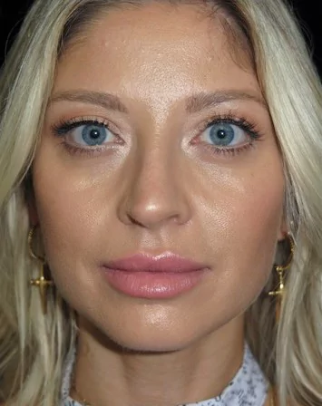 before and after photo on a frontal view of a non-smiling female patient with crooked nose who underwent scarless rhinoplasty