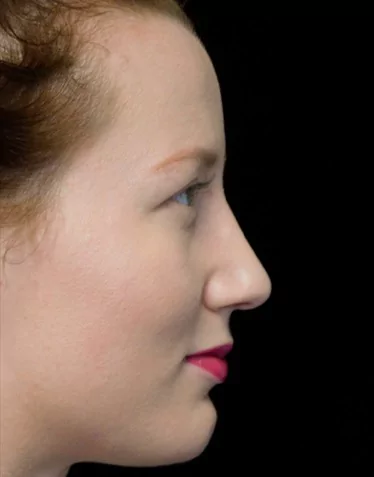 before and after photo on a left profile view of a non-smiling female patient with dorsal hump who underwent scarless rhinoplasty