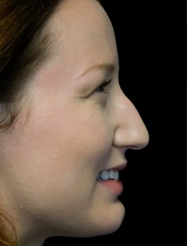 before and after photo on a left profile view of a smiling female patient with dorsal hump who underwent non surgical rhinoplasty