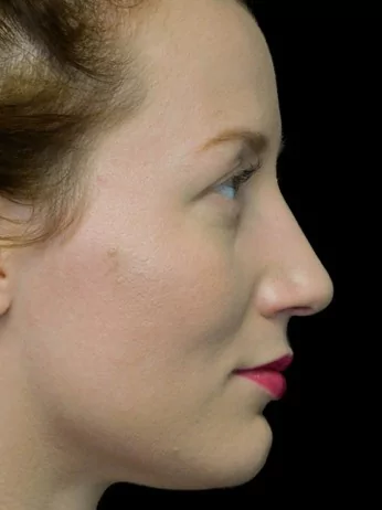 before and after photo on a left profile view of a non-smiling female patient with dorsal hump who underwent non surgical rhinoplasty