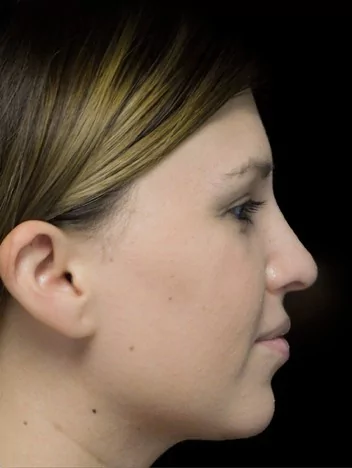before and after photo on a left profile view of a non-smiling female patient with droopy tip nose who underwent scarless rhinoplasty