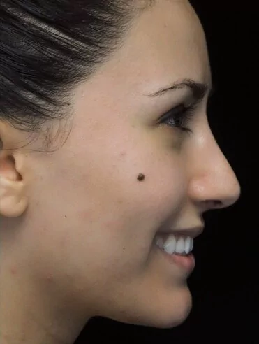 before and after photo on a left profile view of a smiling female european patient  who underwent scarless rhinoplasty