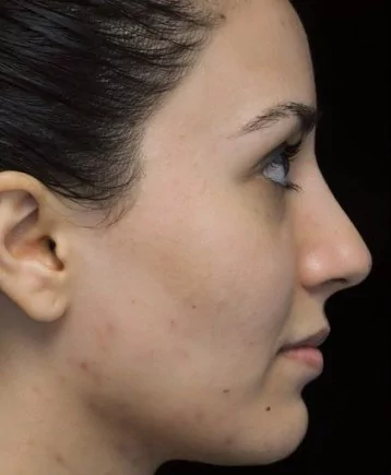 before and after photo on a left profile view of a non-smiling female russian patient  who underwent non-surgical rhinoplasty