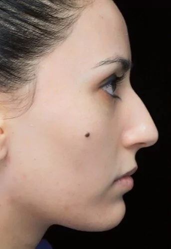 before and after photo on a left profile view of a non-smiling female european patient  who underwent scarless rhinoplasty