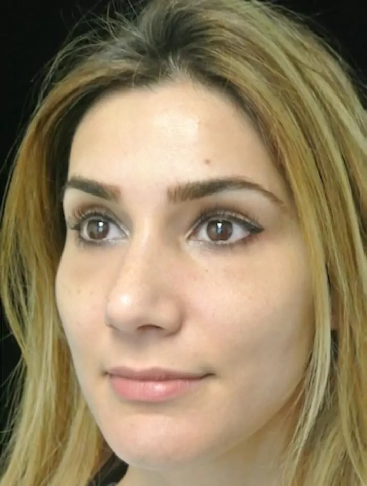 before and after photo on a right profile view of a non-smiling female patient  who underwent scarless rhinoplasty