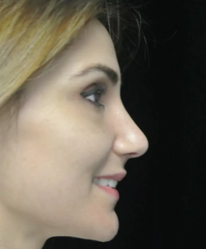 before and after photo on a left profile view of a smiling female patient  who underwent scarless rhinoplasty