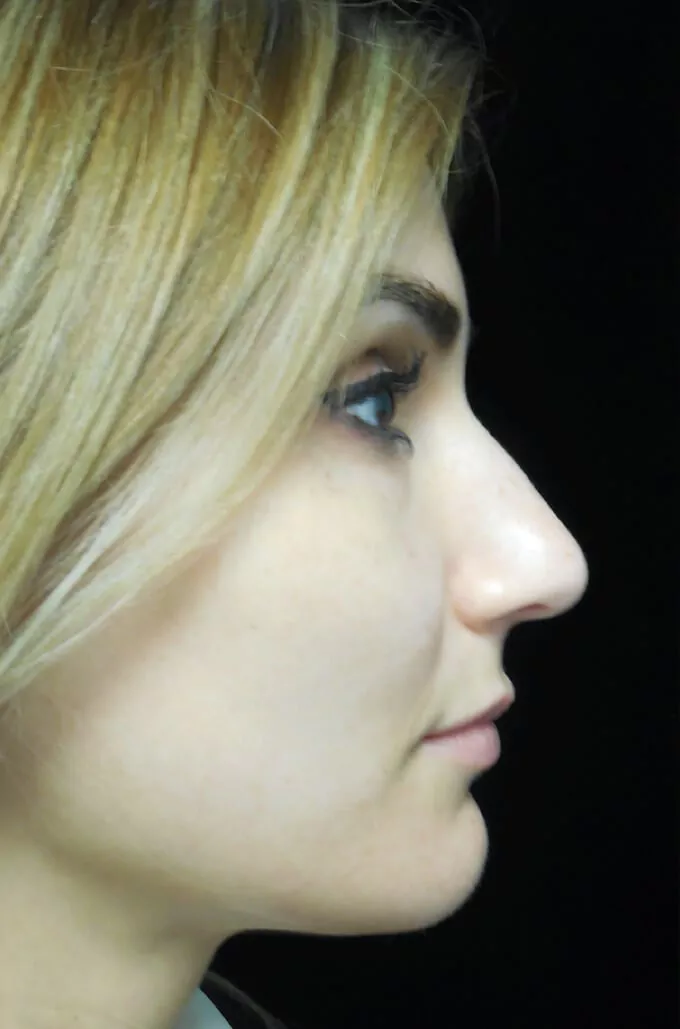 before and after photo on a left profile view of a non-smiling female patient  who underwent scarless rhinoplasty