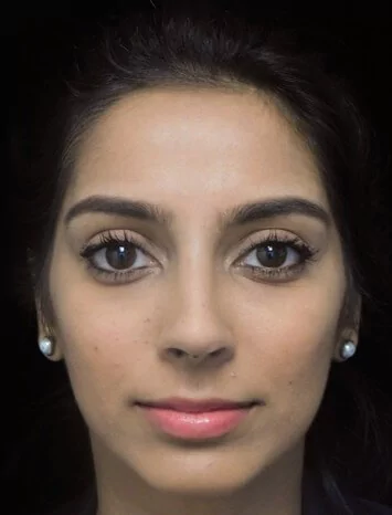 before and after photo on a frontal view of a non-smiling female south asian patient  who underwent non-surgical rhinoplasty
