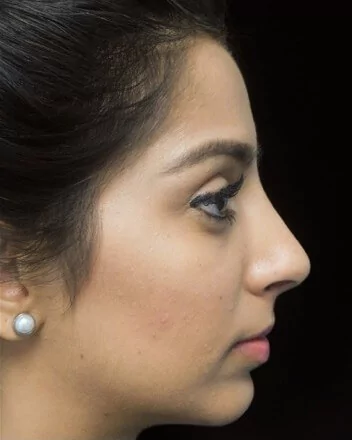 before and after photo on a left profile view of a non-smiling female south asian patient  who underwent non-surgical rhinoplasty