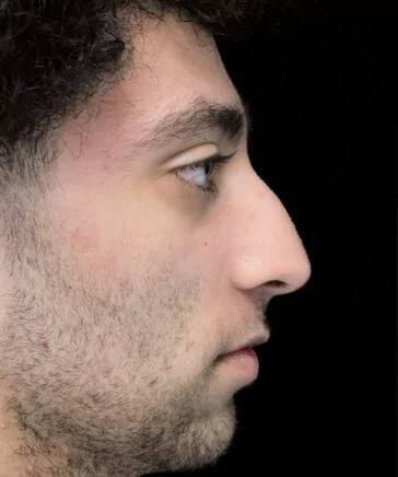 before and after photo on a left profile view of a non-smiling male patient  who underwent scarless rhinoplasty