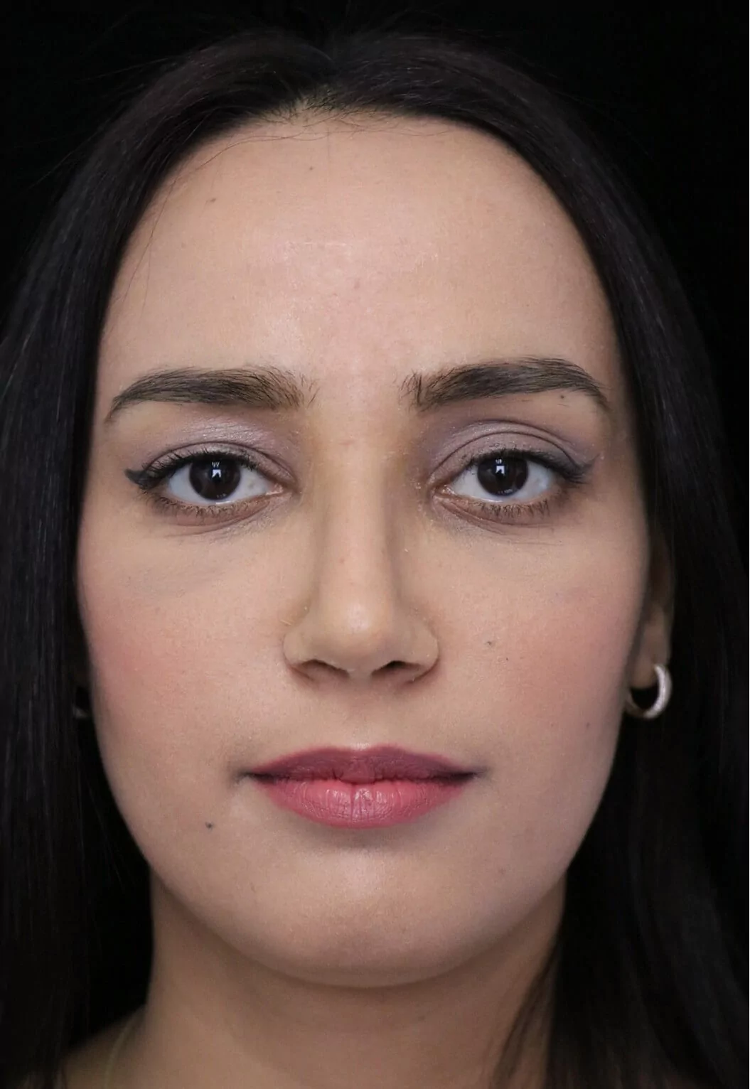 before and after photo on a frontal view of a non-smiling female middle eastern patient  who underwent non-surgical rhinoplasty