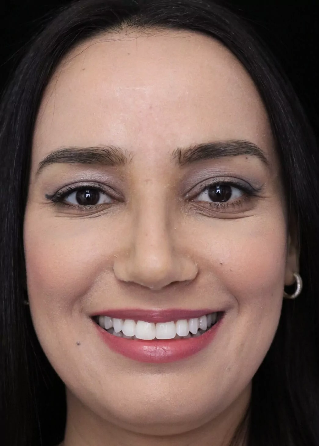 before and after photo on a frontal view of a smiling female middle eastern patient  who underwent non-surgical rhinoplasty