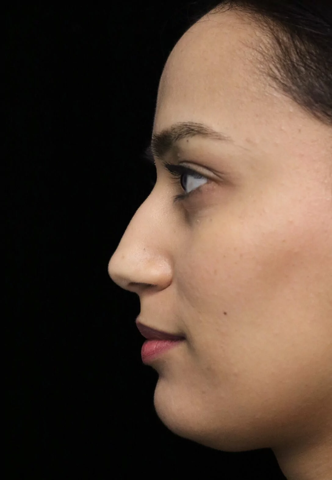 before and after photo on a right profile view of a non-smiling female middle eastern patient  who underwent non-surgical rhinoplasty