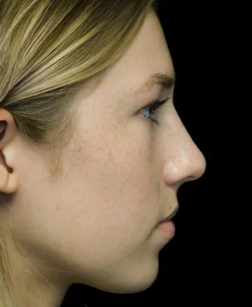 before and after photo on a left profile view of a non-smiling female russian patient  who underwent scarless rhinoplasty