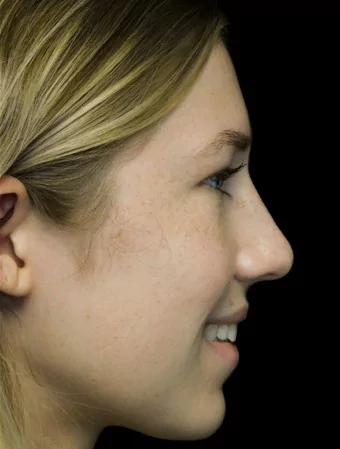 before and after photo on a left profile view of a smiling female russian patient  who underwent scarless rhinoplasty