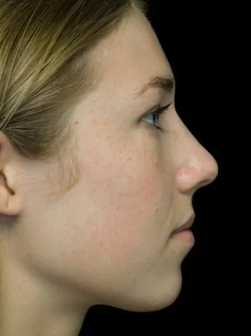 before and after photo on a left profile view of a non-smiling female russian patient  who underwent non surgical rhinoplasty