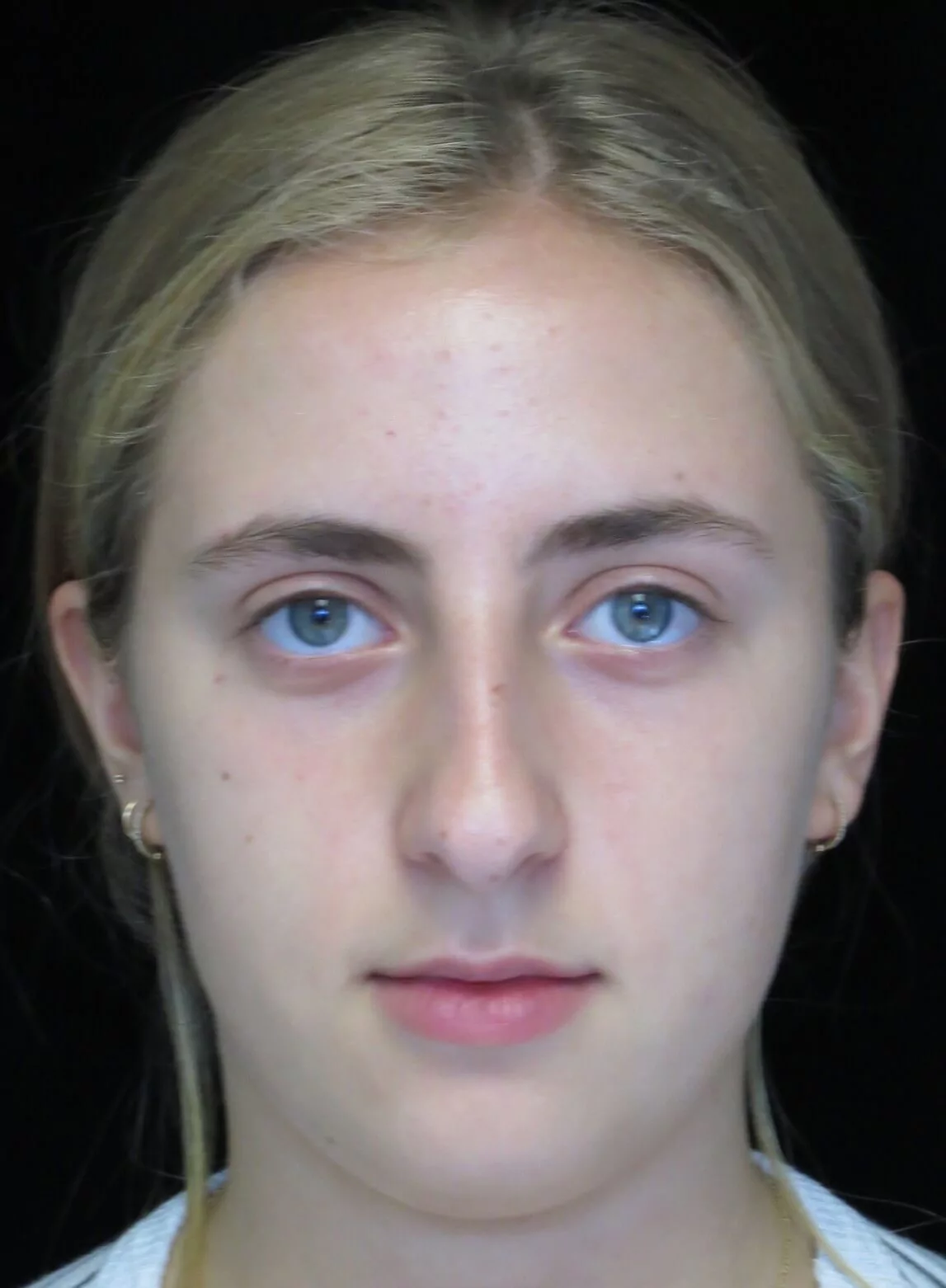 before and after photo on a frontal view of a non-smiling teenage female patient who underwent scarless rhinoplasty