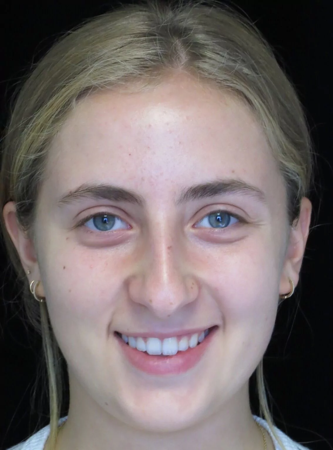 before and after photo on a frontal view of a smiling teenage female patient who underwent scarless rhinoplasty