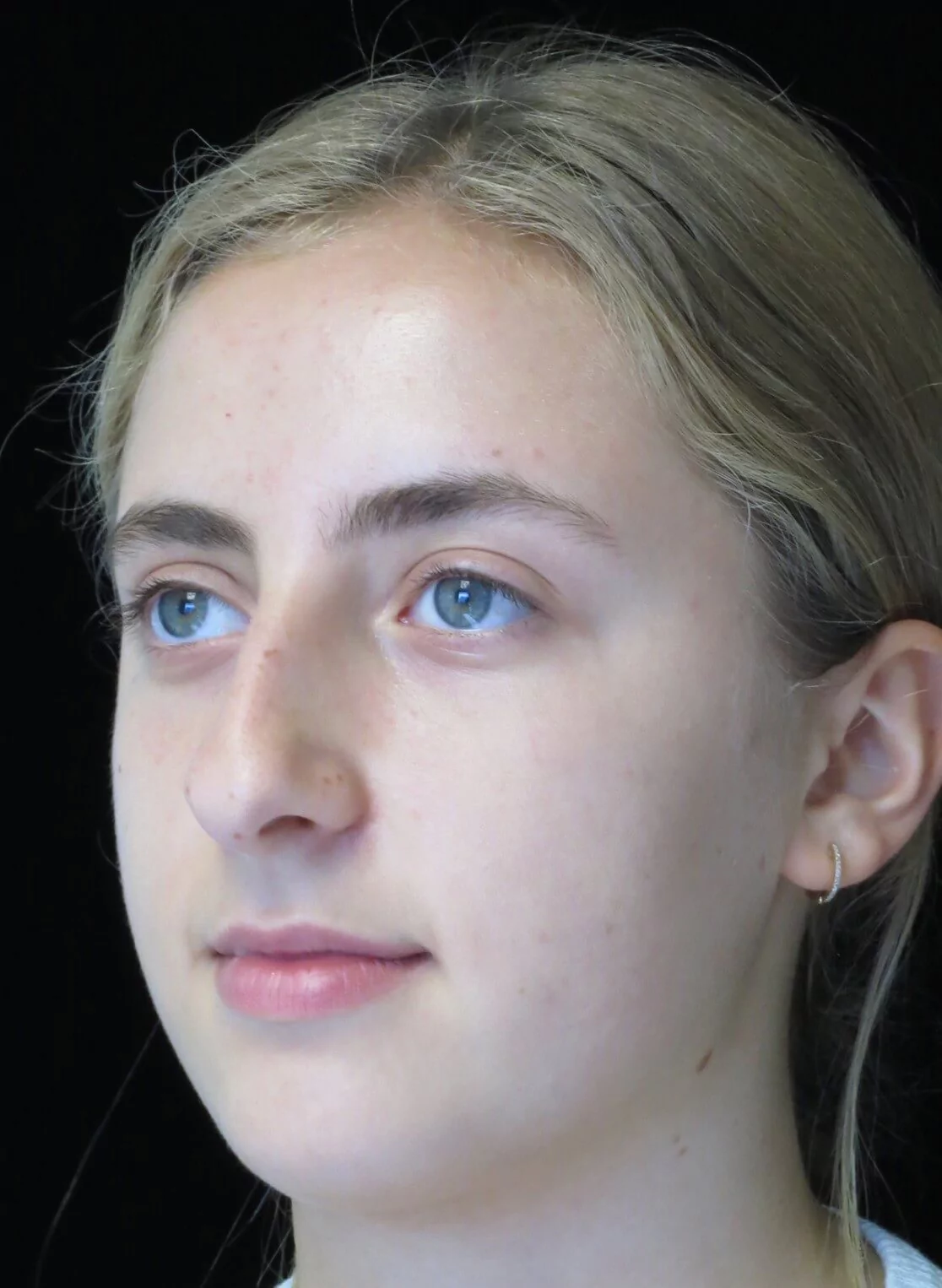 before and after photo on a right profile view of a non-smiling teenage female patient who underwent scarless rhinoplasty