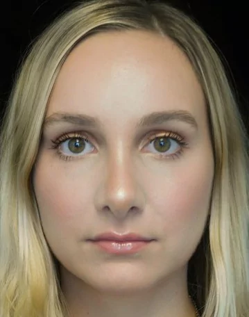 before and after photo on a frontal view of a non-smiling female patient with wide nasal bones who underwent scarless rhinoplasty