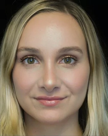 before and after photo on a frontal view of a smiling female patient with wide nasal bones who underwent scarless rhinoplasty