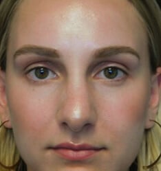 before and after shot of a patient who underwent a bulbous tip rhinoplasty