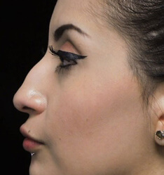 before and after shot of a patient who underwent a non surgical rhinoplasty