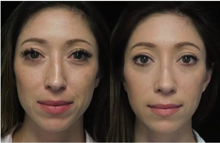 before and after surgery photo of an asian nose job patient