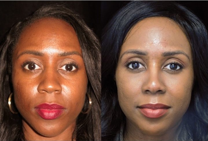 before and after of an african american nose job