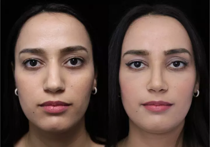 before and after surgery photo of a middle east rhinoplasty
