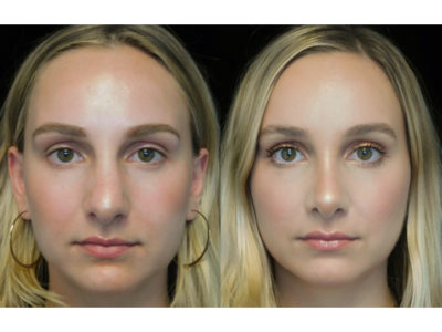 Female patient of the top rhinoplasty surgeon in the USA