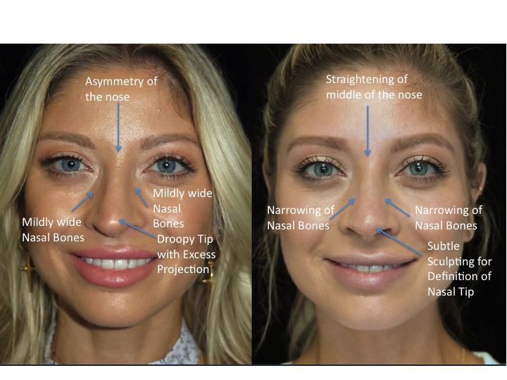 Illustration of a female patient with droopy nose tip who underwent a closed scarless nose job tip refinement