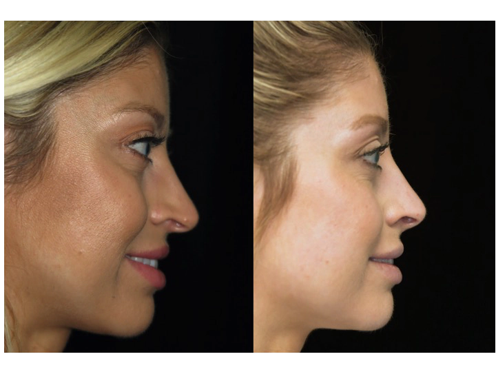 Illustration of a female patient with droopy nose tip who underwent a closed rhinoplasty tip refinement
