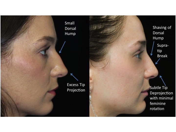 Nose job before and after of a female with small dorsal hump