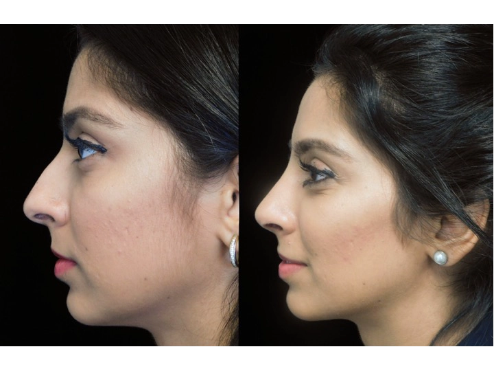 Illustration of a woman who underwent closed rhinoplasty tip refinement