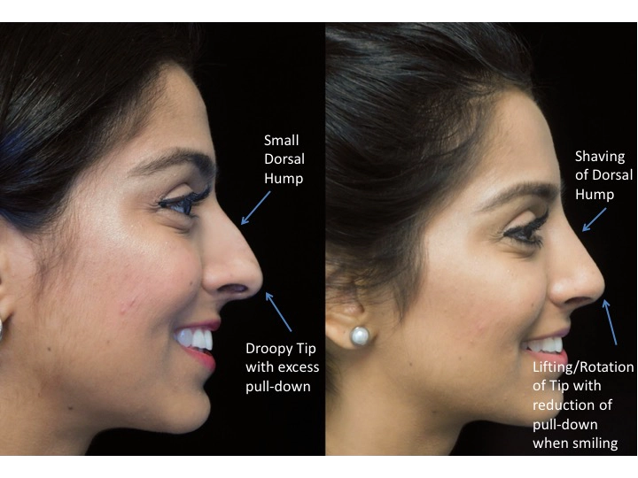 Illustration of a woman who underwent closed rhinoplasty tip refinement