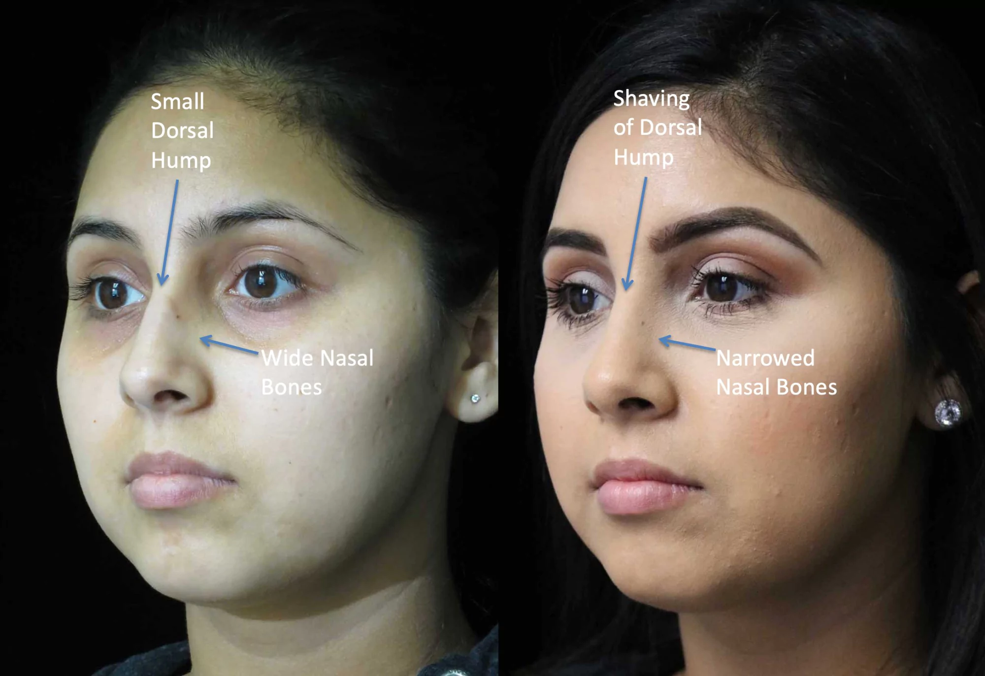 nose job before and after illustration of a woman with wide nasal bones