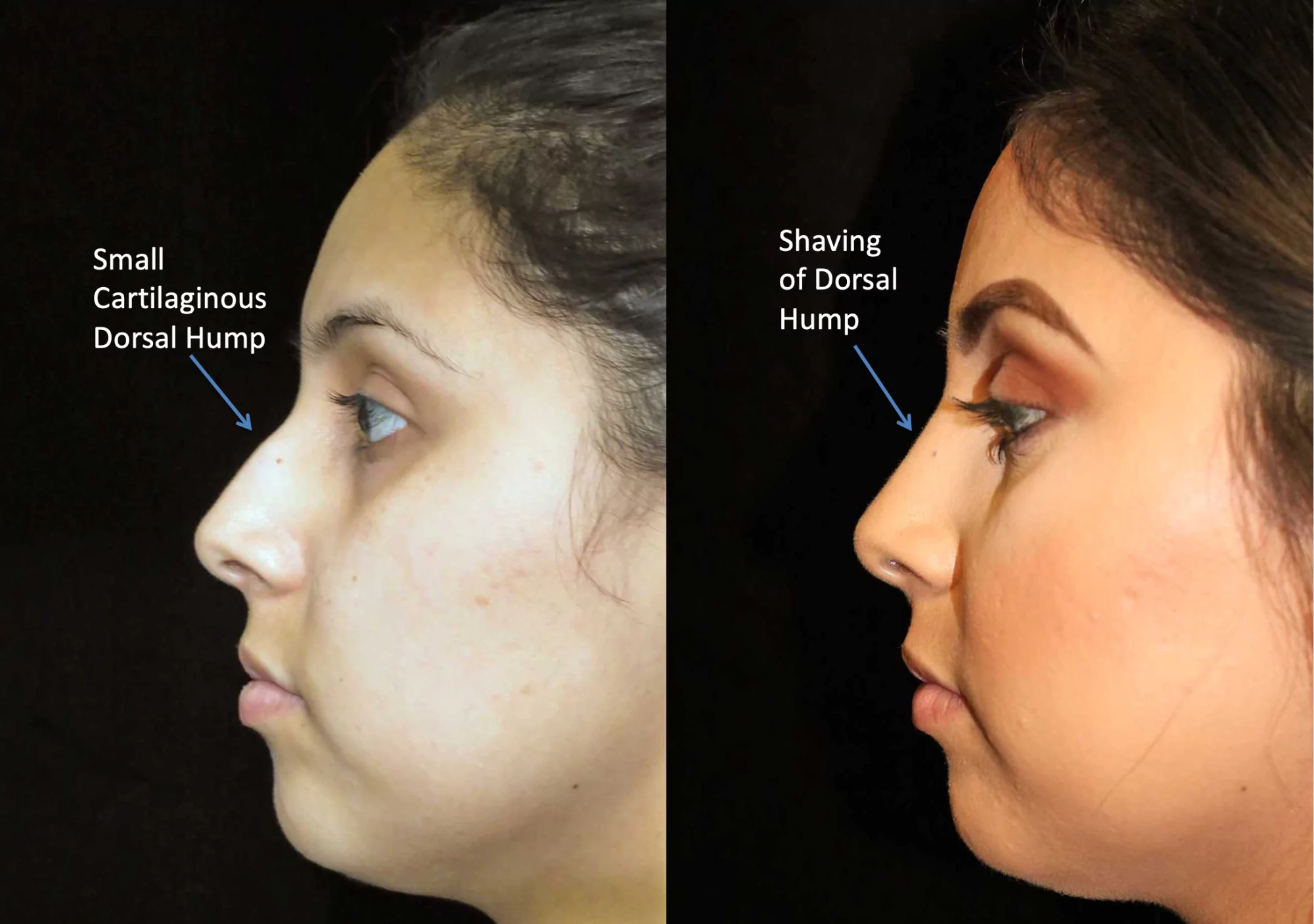 nose job before and after illustration of a woman with wide nasal bones