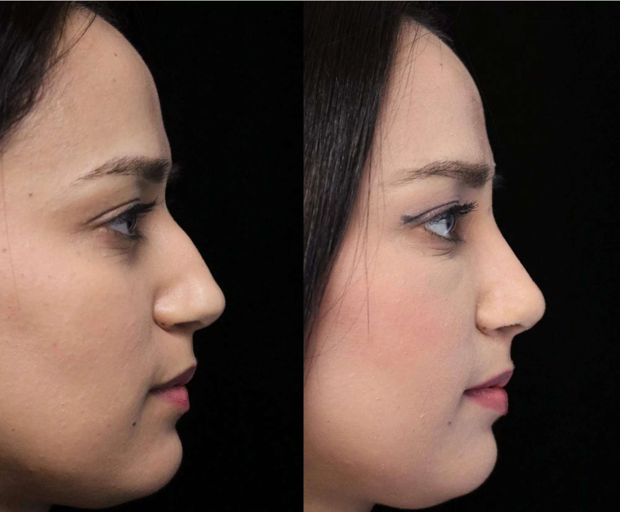 closed rhinoplasty before and after illustration of a woman with small dorsal hump