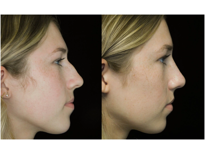 before and after photo of a young woman with a bulbous tip nose who underwent nose job tip reduction