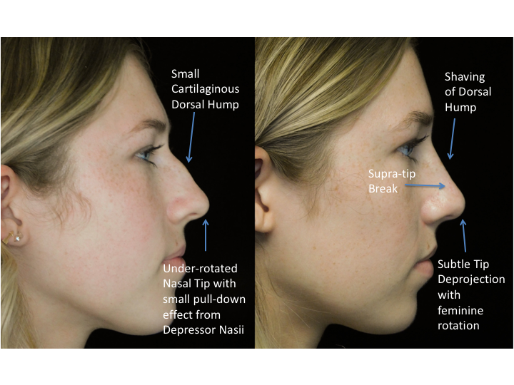 a woman who underwent rhinoplasty before and after illustration