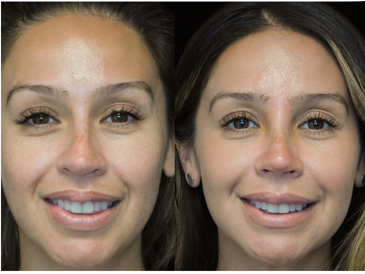 before and after photo of a young woman with a bulbous tip nose who underwent bulbous tip reduction