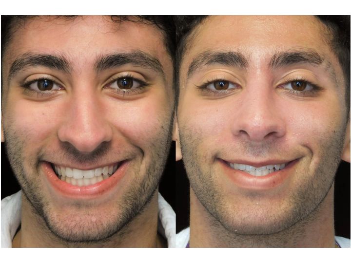 before and after photo of a man who underwent bulbous nasal tip rhinoplasty