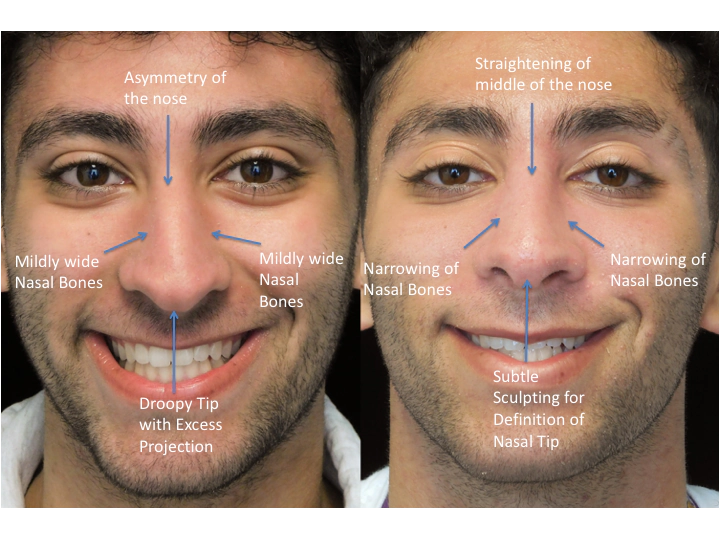 Before and after photo of a man who underwent bulbous nasal tip rhinoplasty